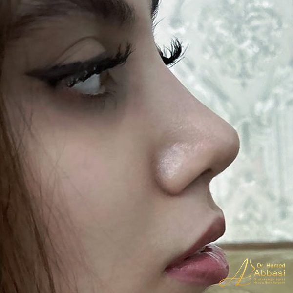 صور من جراحات الأنف للدكتور عباسي