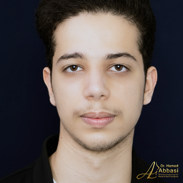 جراحة الأنف على يد الدكتور حامد عباسي