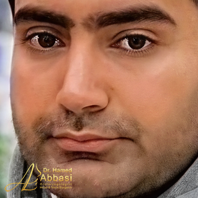 صور عمليات تجميل الأنف للدكتور عباسي