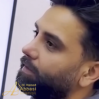 صور عمليات تجميل الأنف للدكتور عباسي
