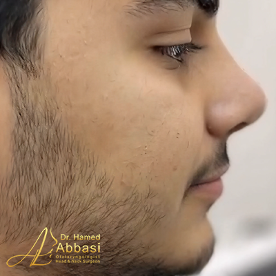 صور عمليات تجميل الأنف للدكتور عباسي
