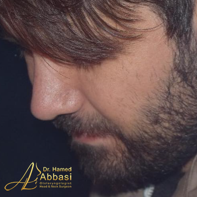 صور عمليات تجميل الأنف للدكتور عباسي