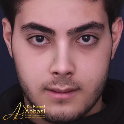 صور عمليات تجميل الأنف للدكتور عباسي